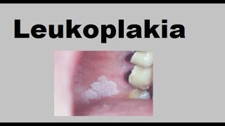 Leukoplakia [upl. by Nivlam]